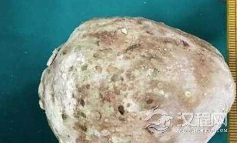 世界上最大的肾结石，长达10厘米重达2.8斤的疯狂石头